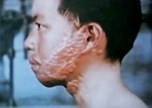 A child survivor and burn victim; Hiroshima